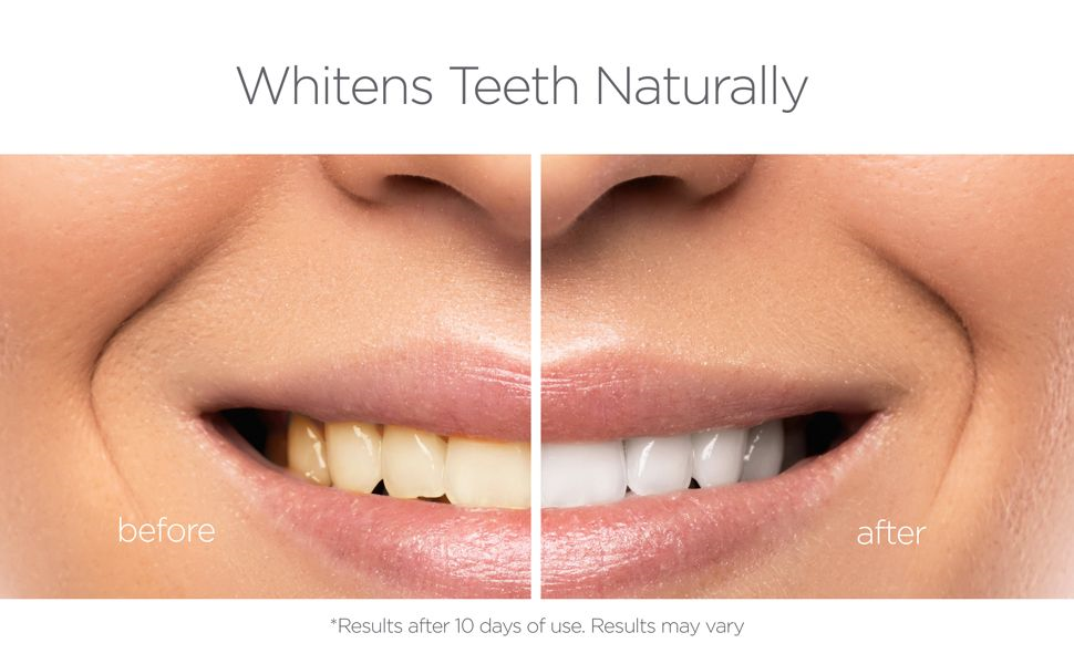 Whiter Teeth - Before and After difference with ORL